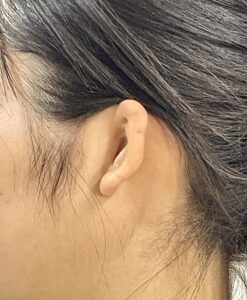 耳エピテーゼ　装着前