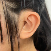 耳エピテーゼ　装着写真