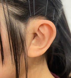 耳エピテーゼ　装着写真